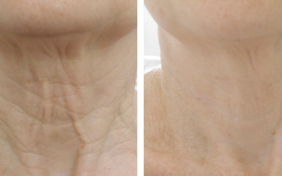 Skin Tightening EndyMed