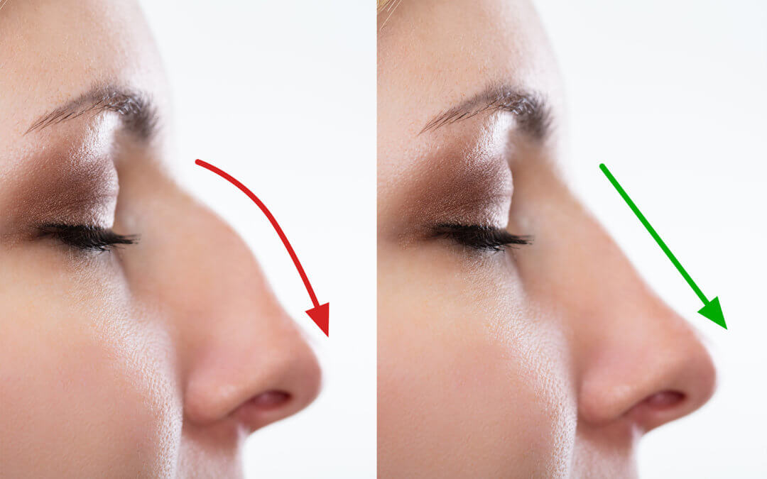 Non surgical Rhinoplasty